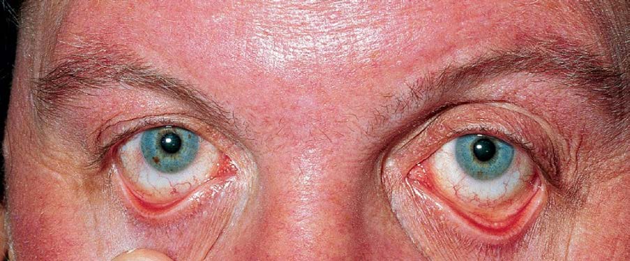 Плетора лица и конъюнктив