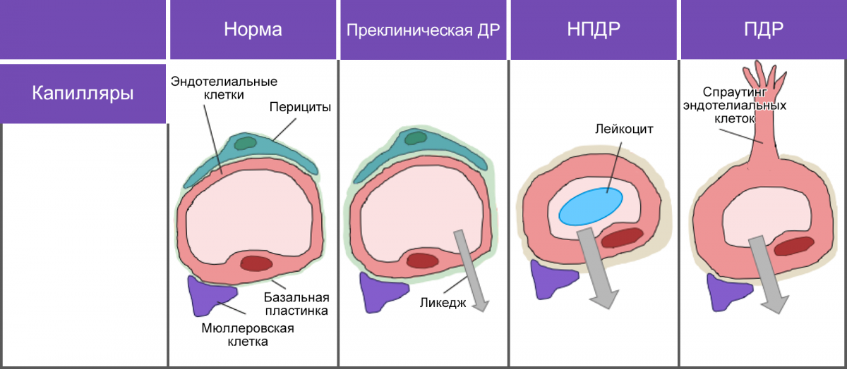 Рисунок 3. Морфологические изменения в зависимости от стадии ДР Рисунок 3. Морфологические изменения в зависимости от стадии ДР