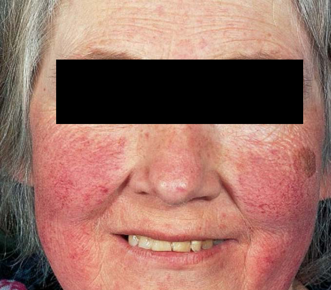 Сохранение розацеа средней и нижней трети лица