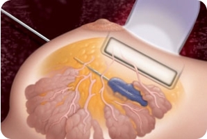 Стереотаксическая пункционная биопсия (СТБ)