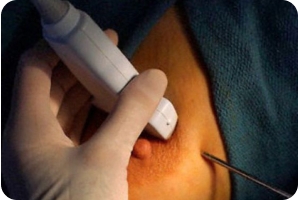 Трепан-биопсия молочной железы