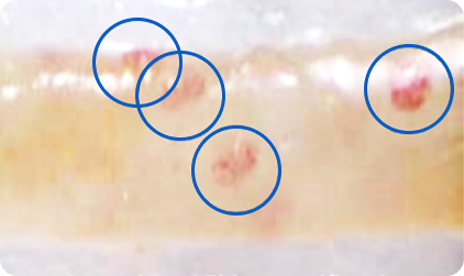 Этап забора биоптата Этап забора биоптата