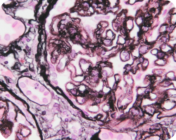 Мезангиальная пролиферация Мезангиальная пролиферация