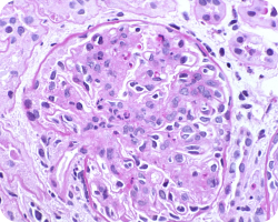 Эндокапиллярная пролиферация Эндокапиллярная пролиферация