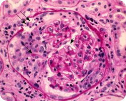 Клеточные или фиброзно-клеточные полулуния Клеточные или фиброзно-клеточные полулуния