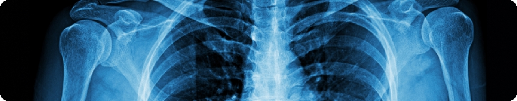 Можно ли выявить ПсА вовремя: основные предикторы прогрессирования поражения суставов Василенко А.А.