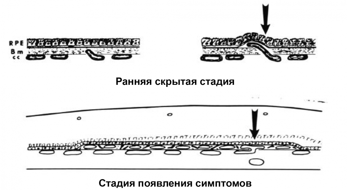 ХНВ 1 типа: черные стрелки показывают рост новых капилляров из хориокапилляров через мембрану Бруха и между базальной мембраной РПЭ и утолщенным и дегенеративно измененным внутриколлагеновым слоем мембраны Бруха ХНВ 1 типа: черные стрелки показывают рост новых капилляров из хориокапилляров через мембрану Бруха и между базальной мембраной РПЭ и утолщенным и дегенеративно измененным внутриколлагеновым слоем мембраны Бруха