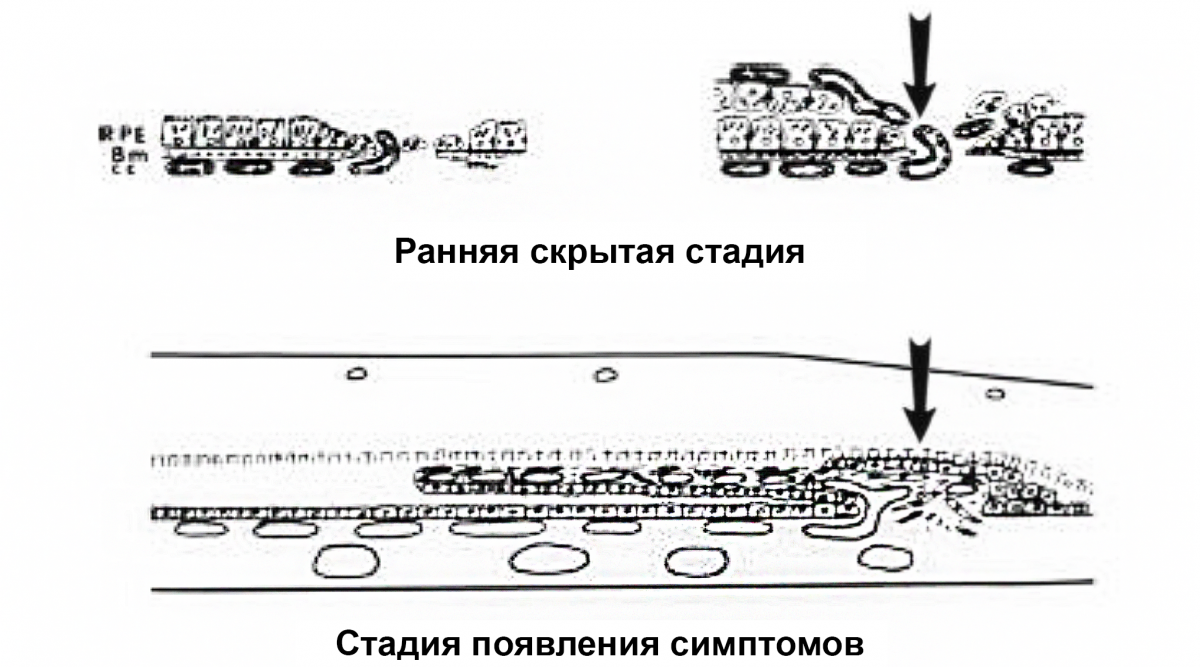 ХНВ 2 типа: черные стрелки показывают рост новых капилляров из хориокапилляров через дефект в локально поврежденной мембране Бруха в пространство под нейроэпителием вдоль участка пролиферирующего ХНВ 2 типа: черные стрелки показывают рост новых капилляров из хориокапилляров через дефект в локально поврежденной мембране Бруха в пространство под нейроэпителием вдоль участка пролиферирующего