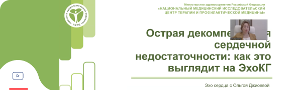 ОДСН на ЭхоКГ ОДСН на ЭхоКГ