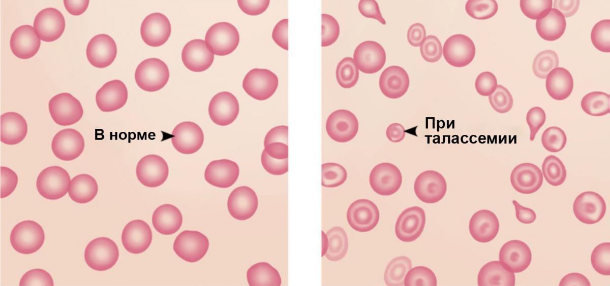 Рисунок 3. Эритроциты в норме и при талассемии Рисунок 3. Эритроциты в норме и при талассемии