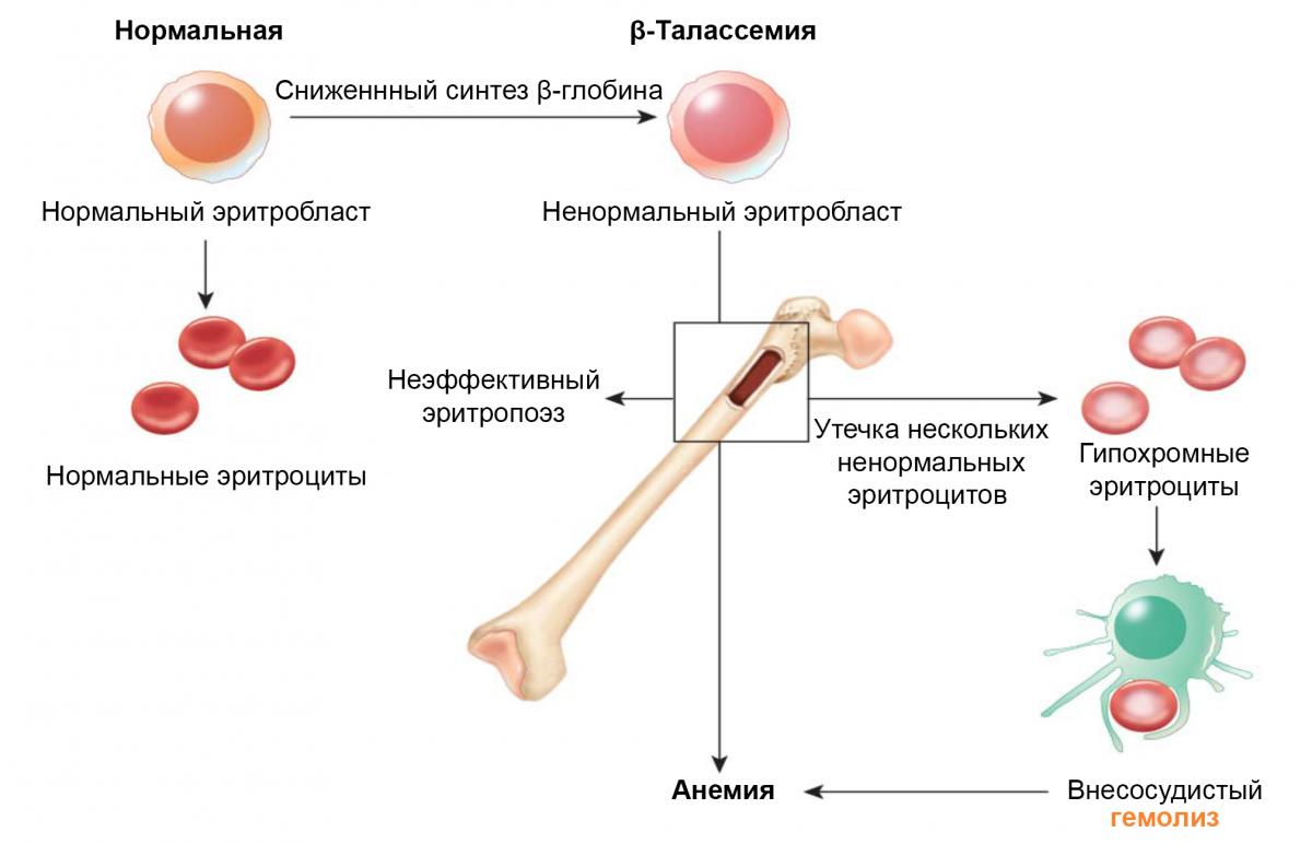 Рисунок 4. Патогенез β-талассемии Рисунок 4. Патогенез β-талассемии
