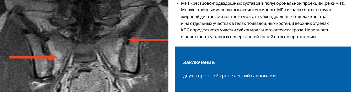 МРТ крестцово-подвздошных суставов МРТ крестцово-подвздошных суставов