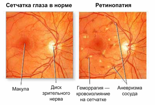 Изменения глазного дна при НПДР Изменения глазного дна при НПДР