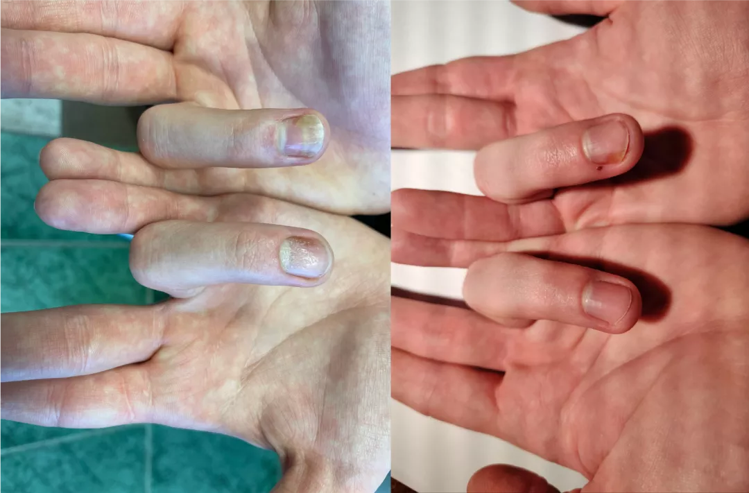 Длительный период активного лечения у дерматолога с назначением топической и фототерапии