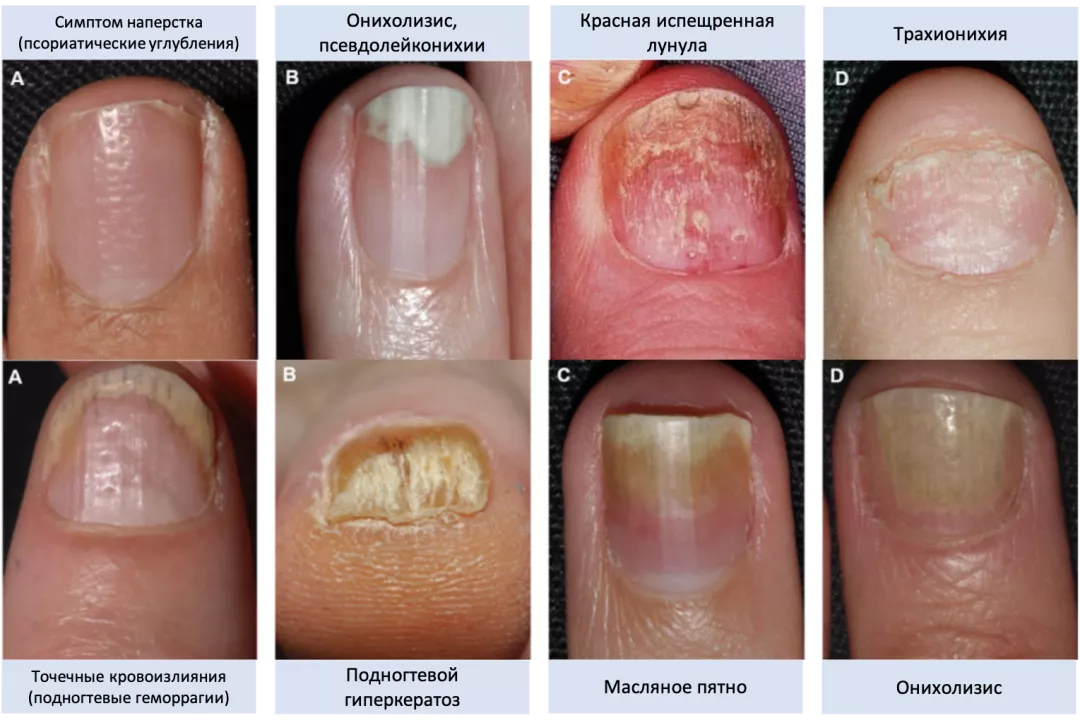 Клинические проявления, связанные с поражением ногтевого ложа: