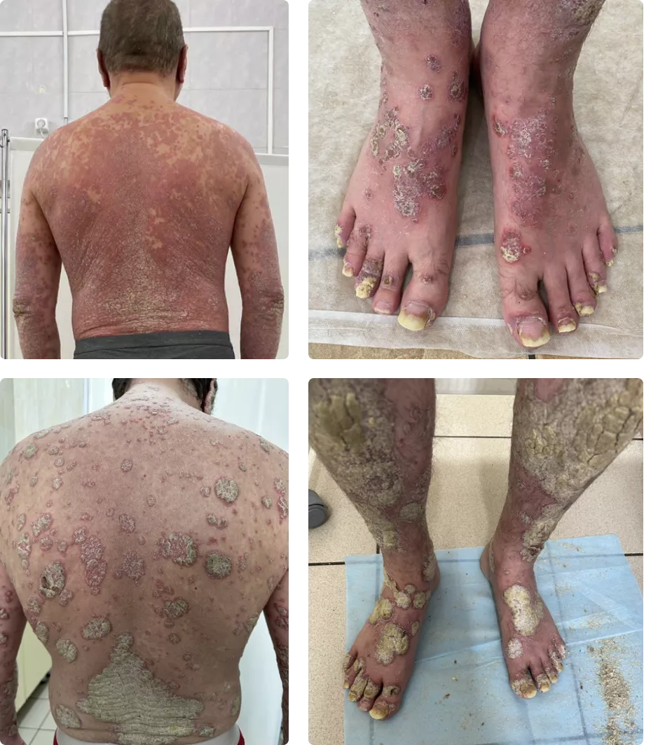 Клинический случай наблюдения пациента с псориазом