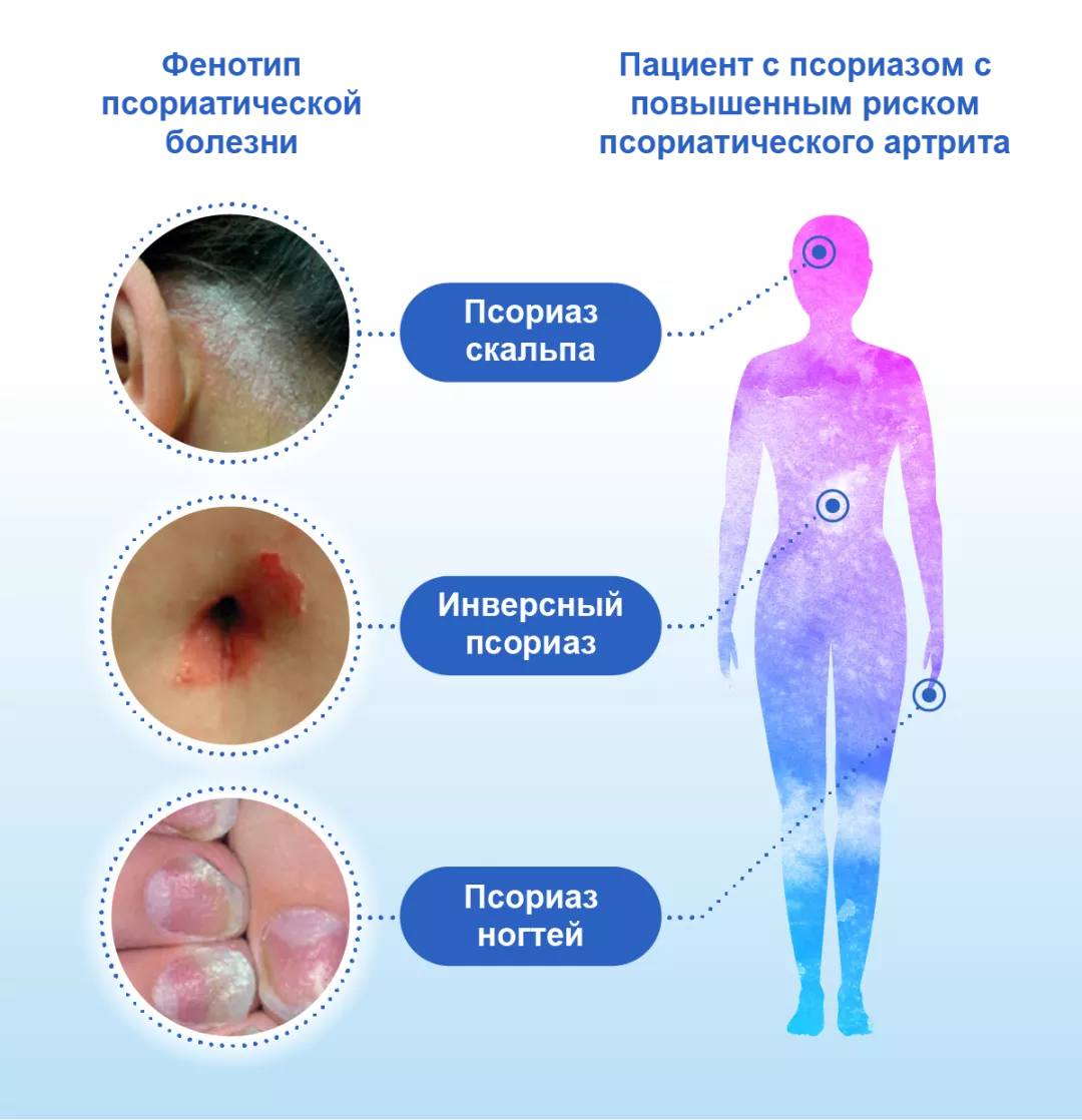 Портрет пациента с рисками развития псориатического артрита