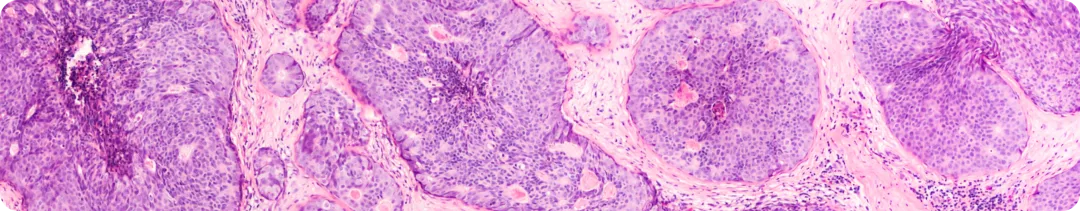Влияние лечения рака молочной железы на нейрокогнитивные способности
