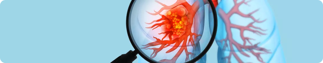 Эпидемиология, этиологические факторы, классификация НМРЛ