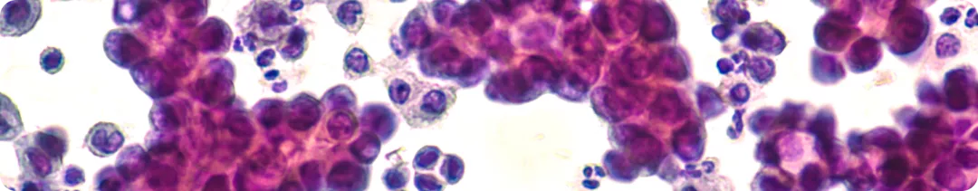 Особенности диагностики и лечения ALK + НМРЛ