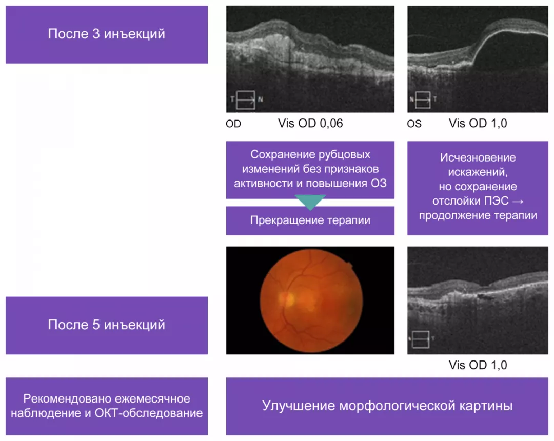 Динамика изменений у больной Б. на фоне анти-VEGF-терапии