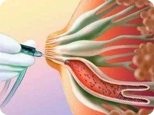 Дуктография