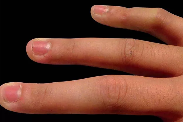 Изолированное временное покраснение