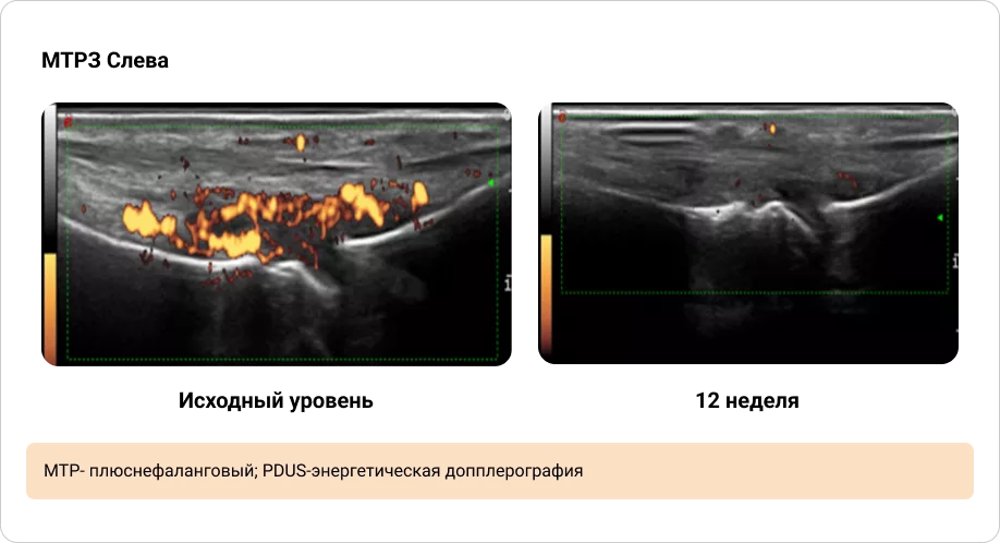 Иллюстрация динамики синовита, выявленного при PDUS исходно и через 12 недель терапии (1/2)