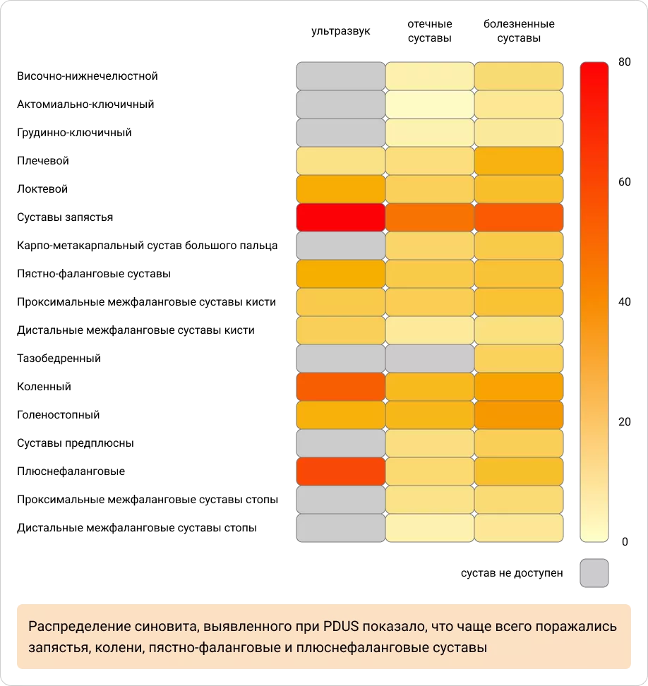 Исходное распределение синовита, выявленного при УЗИ в контексте с исходным распределением болезненных (TJC) и отечных (SJC) суставов
