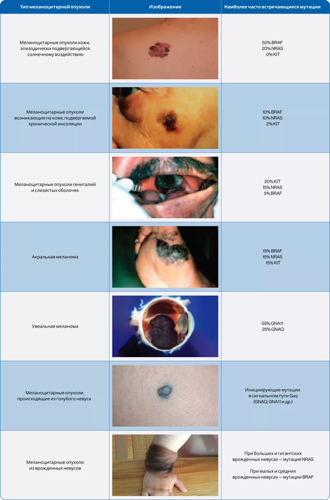 Классификация меланомы