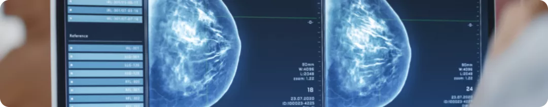 Маммография и дуктография