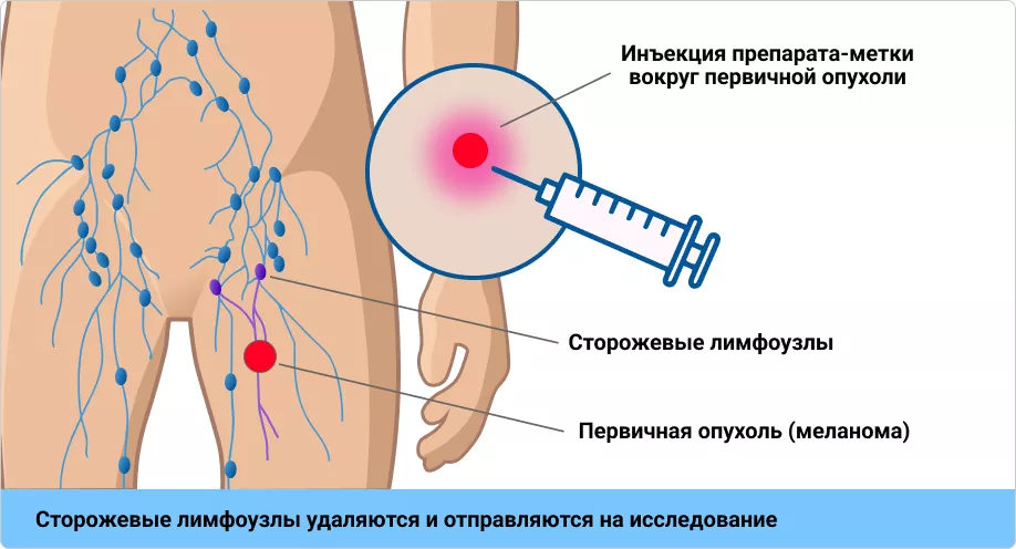 Методика проведения БСЛУ.