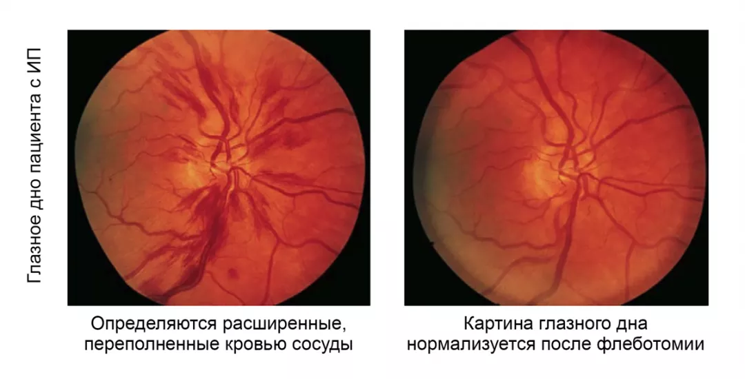 Нарушение зрения, расстройства внимания
