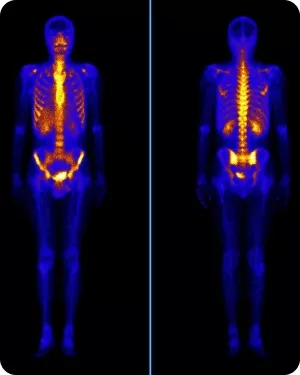 Остеосцинтиграфия