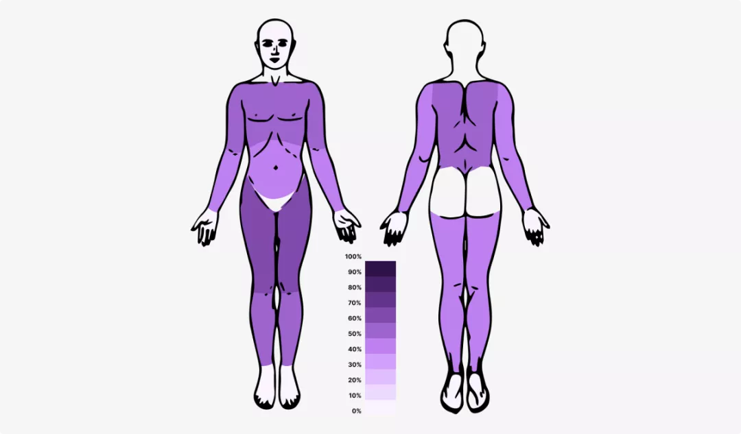 Относительная распространенность локализации аквагенного зуда