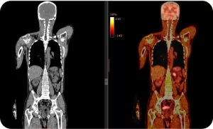 ПЭТ КТ всего тела с 18-ФДГ