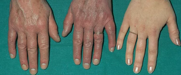 Плетора кистей рук (слева и посередине) в сравнении со здоровой рукой (справа)
