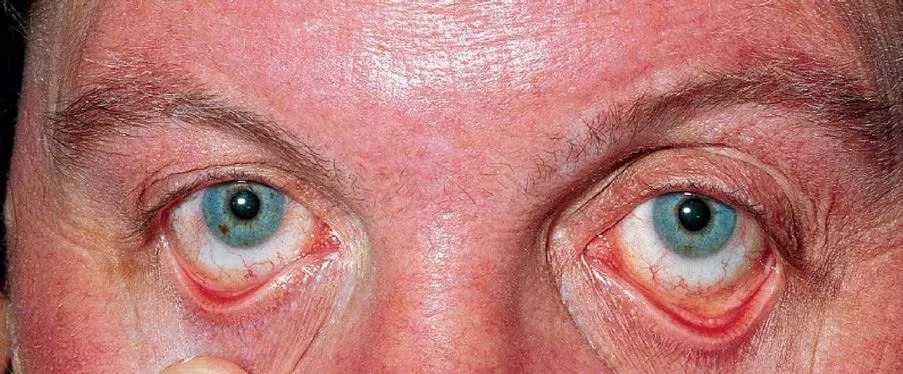 Плетора лица и конъюнктив