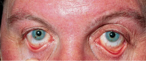 Плетора лица и конъюнктив