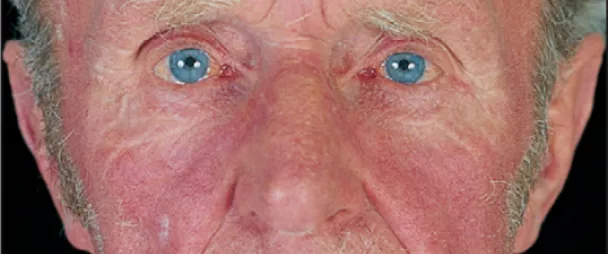 Плетора лица