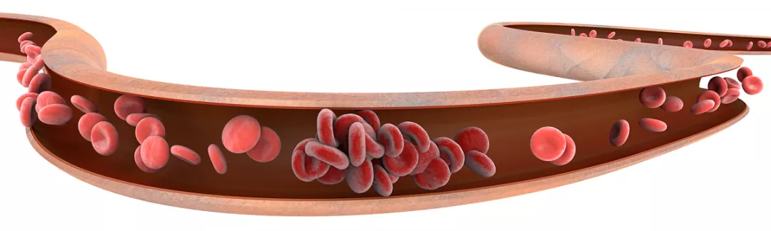 Прогностические факторы (тромбозы)