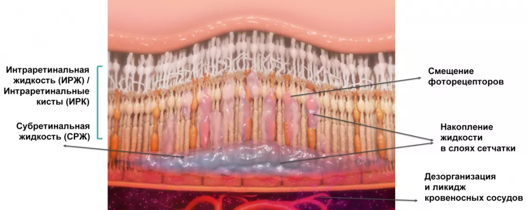 Рисунок 1. Виды жидкости в сетчатке