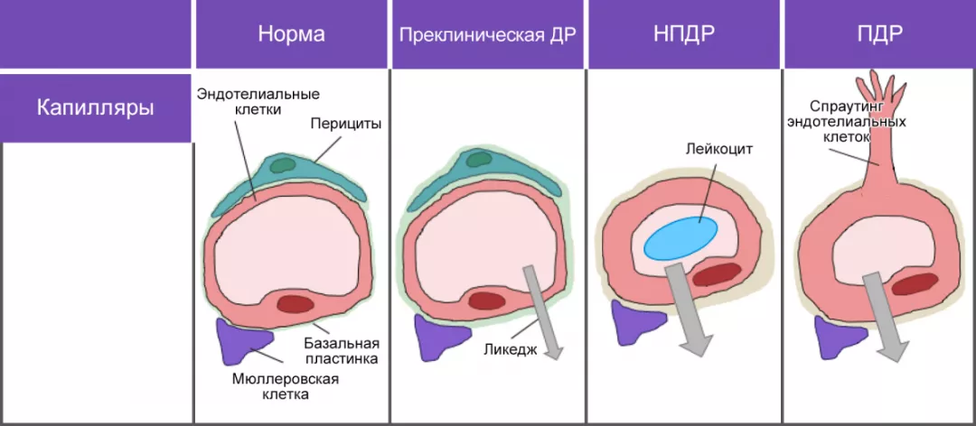 Рисунок 3. Морфологические изменения в зависимости от стадии ДР