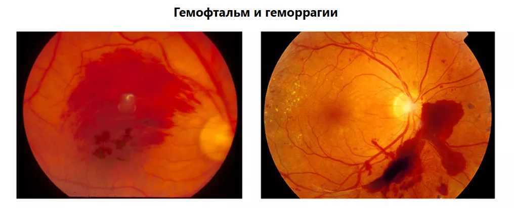 Рисунок 8. Изменения глазного дна при неоваскуляризации