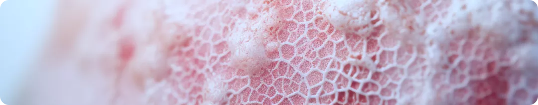 Секукинумаб обеспечивает уменьшение симптоматики ПсА у пациентов с поражением ногтей: фаза III исследования FUTURE 5