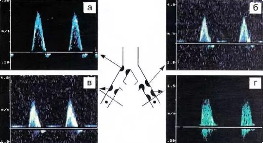 Спектральный анализ кровотока