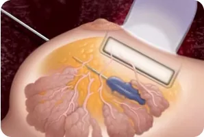 Стереотаксическая пункционная биопсия (СТБ)