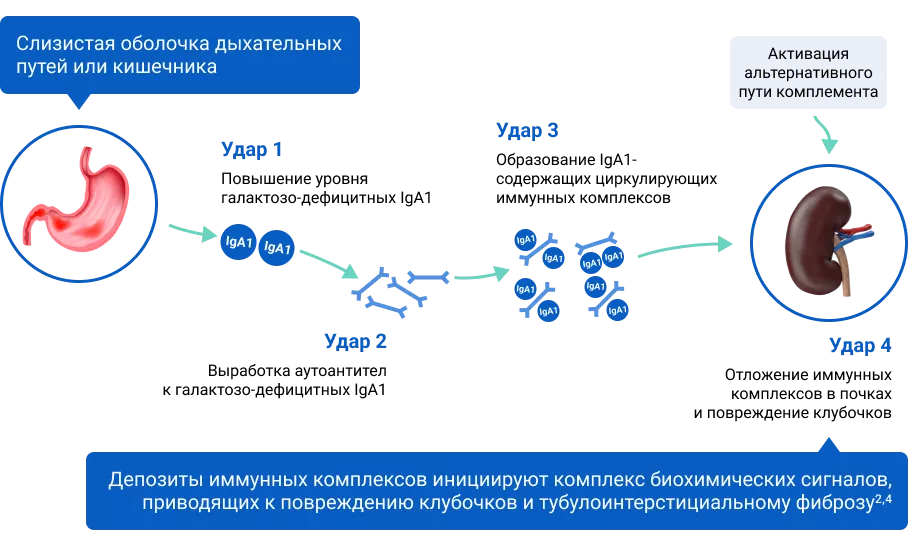 Существует гипотеза о четырехэтапном развитии IgA-нефропатии, в рамках которой предполагается активация пути комплемента