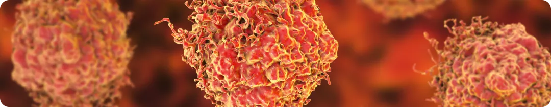 Терапия ОМЛ ингибиторами протеинкиназ