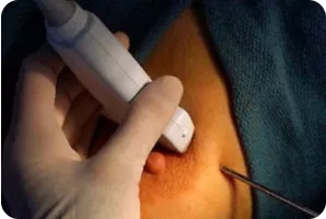 Трепан-биопсия молочной железы